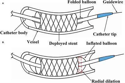 The Performance of a Spherical-tip Catheter for Stent Post-dilation: Finite Element Analysis and Experiments